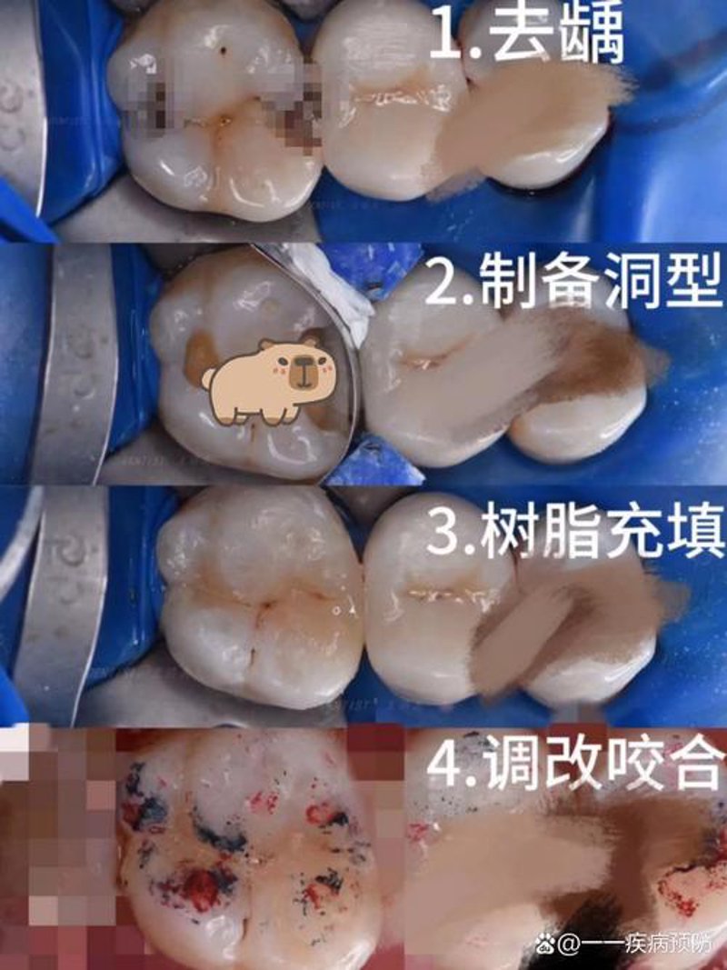 烤瓷牙